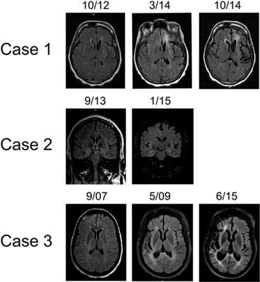 A Case Series of Adult-Onset Rasmussen’s Encephalitis: Diagnostic and Therapeutic Challenges